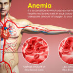 What causes Anemoia?