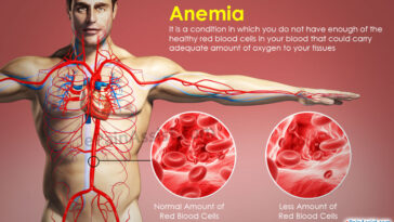 What causes Anemoia?