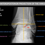 What is a Tibiotalar joint?