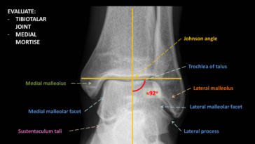 What is a Tibiotalar joint?