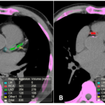 What is an SCA score?