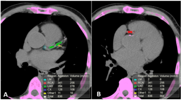 What is an SCA score?