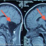 Will an MRI show fluid on the brain?