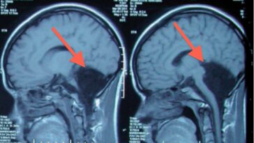Will an MRI show fluid on the brain?