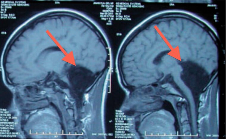 Will an MRI show fluid on the brain?
