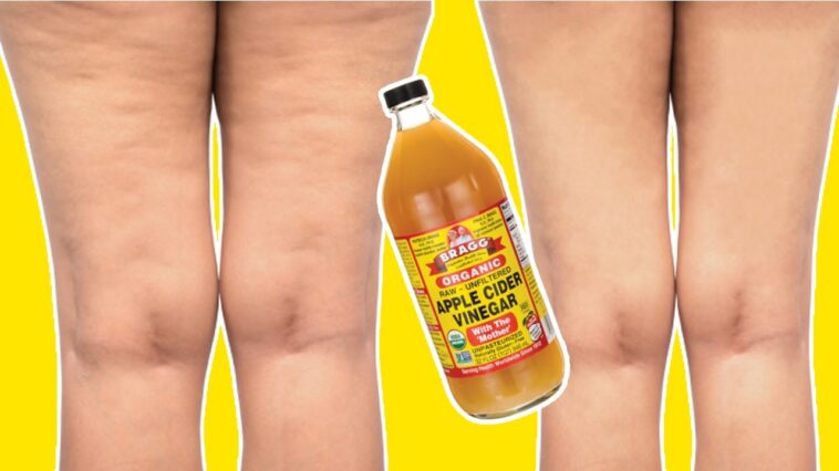 Can Apple cider vinegar get rid of cellulite?