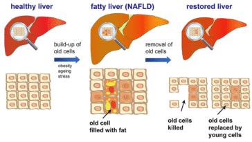 Can Fatty Liver Be Reversed?