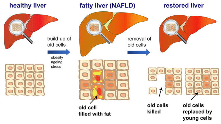 Can Fatty Liver Be Reversed?