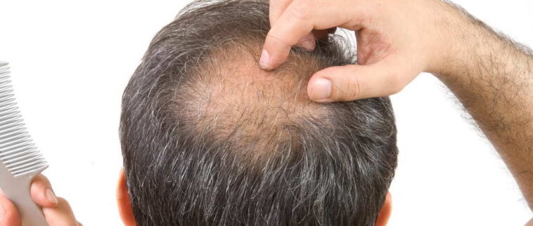 Can black tea cause baldness?