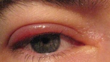 Can cherries cause allergic reaction?