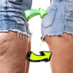 Can flabby thighs be toned?