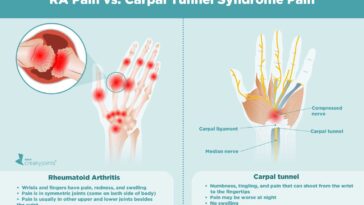 Can hypothyroidism cause rheumatoid arthritis?