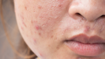 Can pepperoni cause acne?