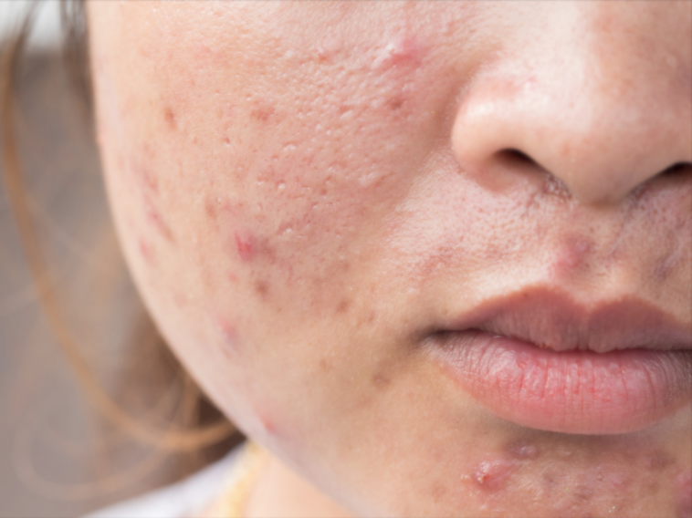 Can pepperoni cause acne?