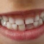 Can salt water tighten loose teeth?
