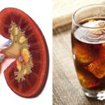 Can soda cause kidney stones?