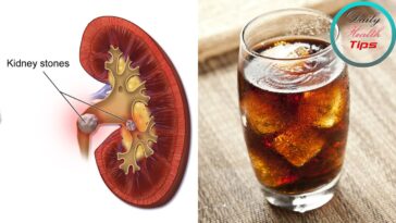 Can soda cause kidney stones?