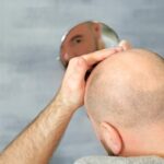 Can too much Vitamin A cause hair loss?