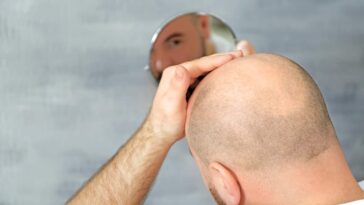 Can too much Vitamin A cause hair loss?