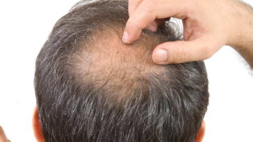 Can too much black tea cause hair loss?