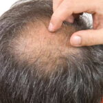 Can too much black tea cause hair loss?