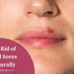 Can vitamin C cause cold sores?