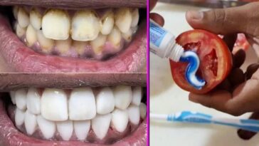 Can yellow teeth become white?