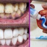 Can yellow teeth become white?
