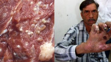 Can you get nandrolone from eating pork?