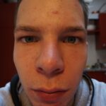 Can you put chlorophyll directly on skin?