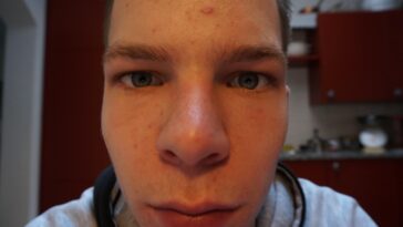 Can you put chlorophyll directly on skin?