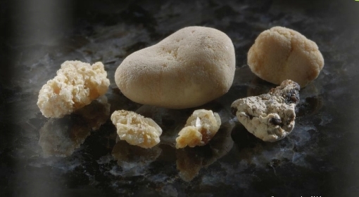 Do water flavor packets cause kidney stones?