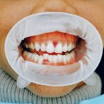Does a throbbing tooth mean infection?