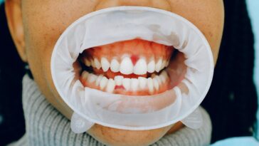 Does a throbbing tooth mean infection?
