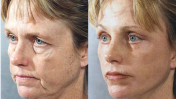 Does collagen make your face fat?