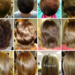 Does dairy cause hair growth?