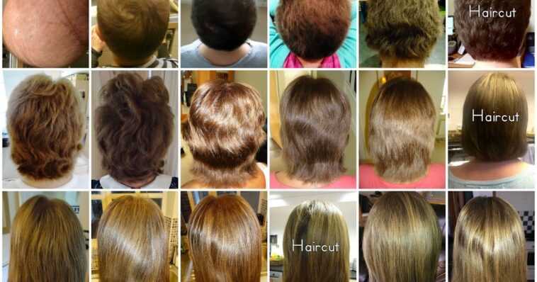 Does dairy cause hair growth?