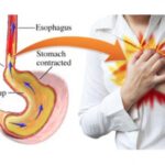 Does fries cause acid reflux?