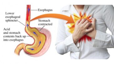 Does fries cause acid reflux?