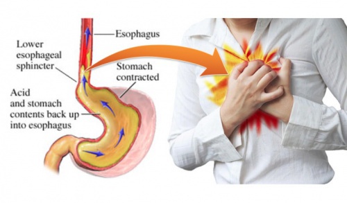 Does fries cause acid reflux?