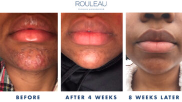 Does mayonnaise cause acne?