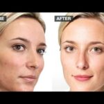 Does milk cause acne?