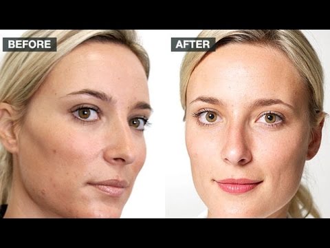 Does milk cause acne?