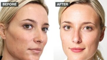 Does milk cause acne?