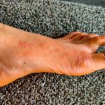 Does skin itch losing weight?