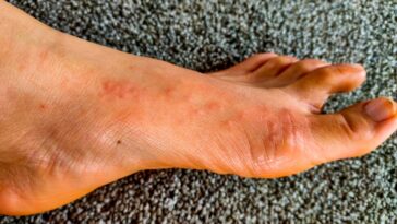 Does skin itch losing weight?