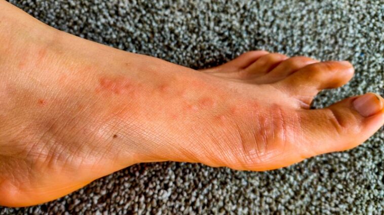 Does skin itch losing weight?