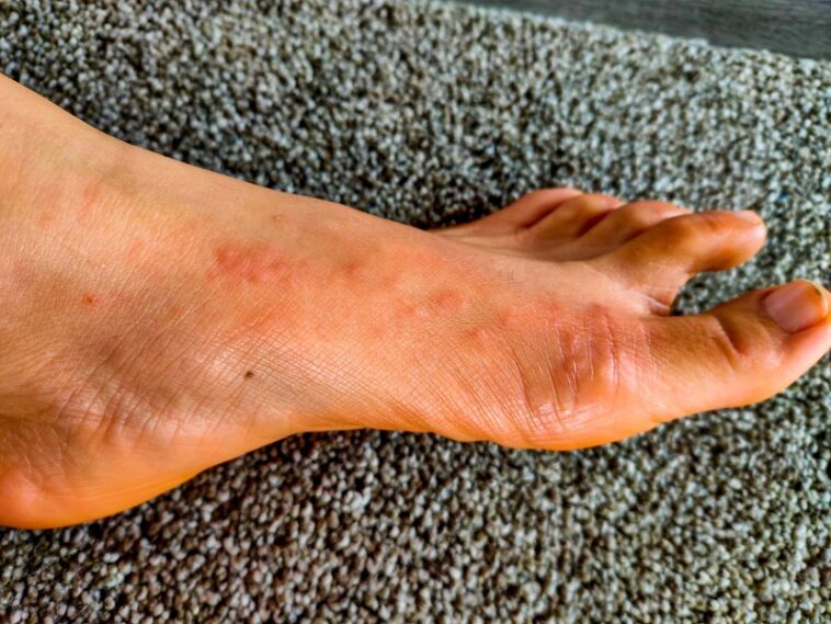 Does skin itch losing weight?