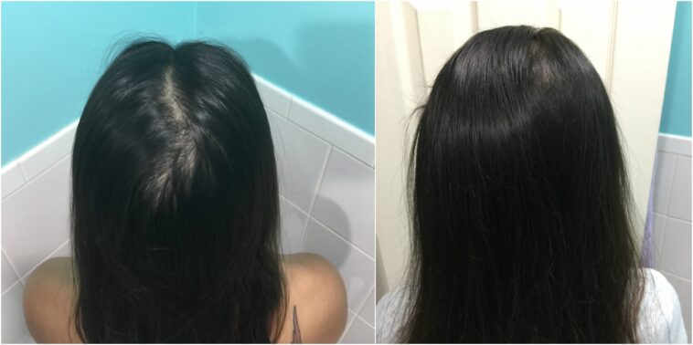 Does sugar help hair growth?