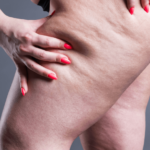 Does walking reduce cellulite?